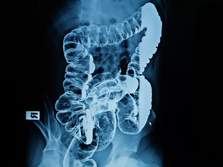 Witamina C hamuje rozwój raka jelita grubego!