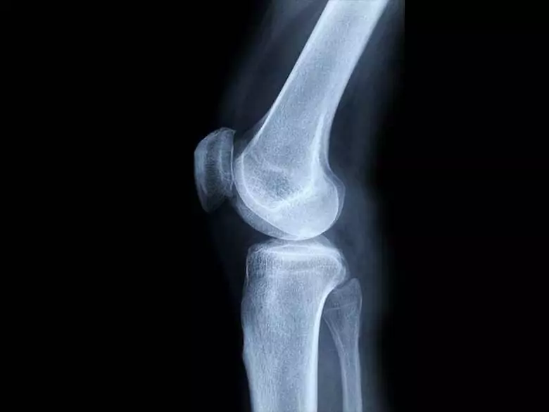 Nowotwór złośliwy kości – przyczyny oraz czynniki ryzyka
