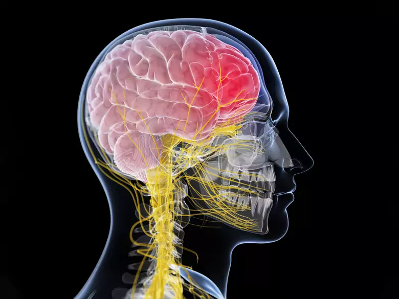 Nowotworowe zapalenie opon mózgowo-rdzeniowych