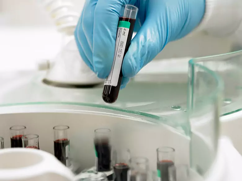 Badanie krwi a podejrzenie raka