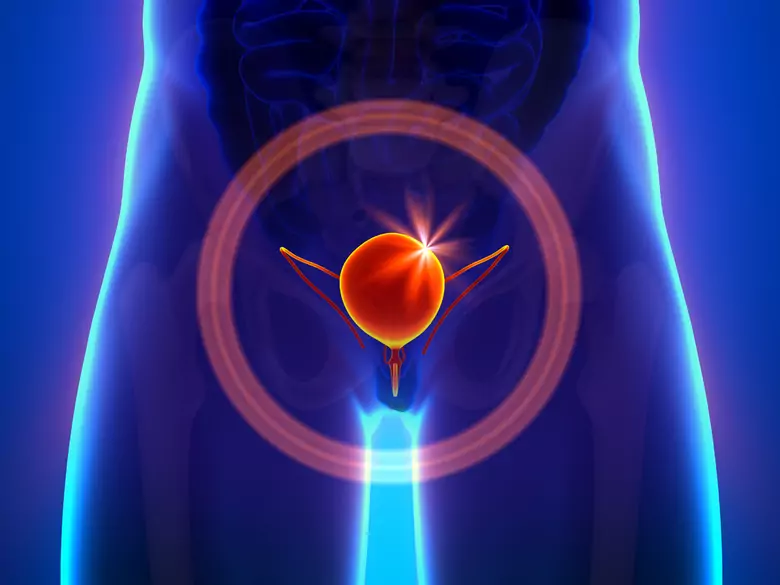 Fakty i mity o raku pęcherza moczowego. Co warto wiedzieć?